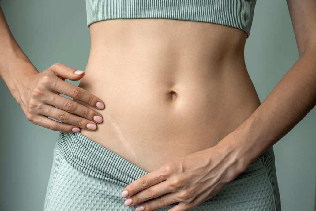 Jizva po císařském řezu