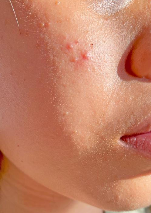 Akné s bílou hlavičkou