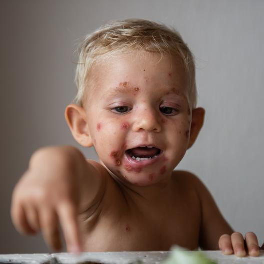 Impetigo