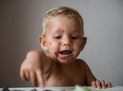 Impetigo