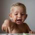 Impetigo