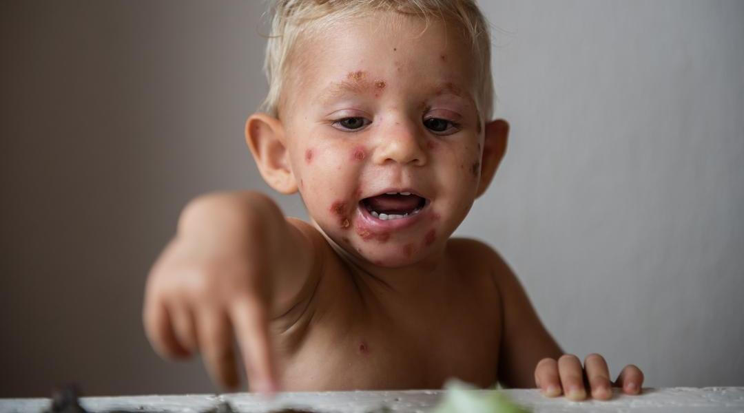 Impetigo