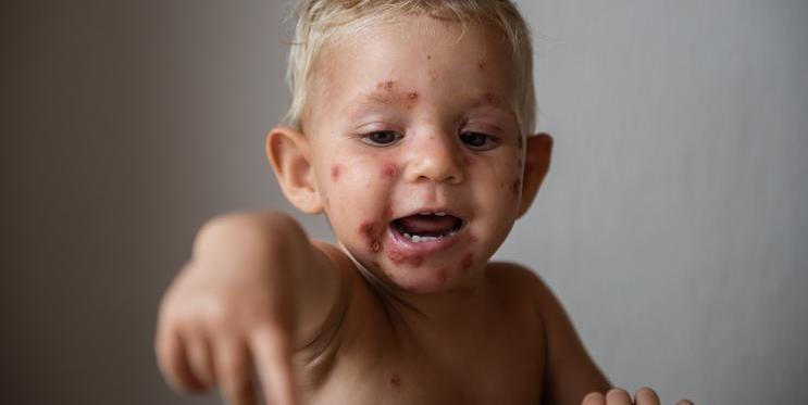 Impetigo