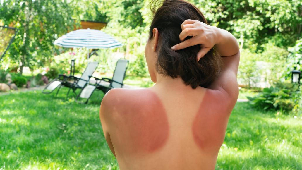 Žena spálená od slunce