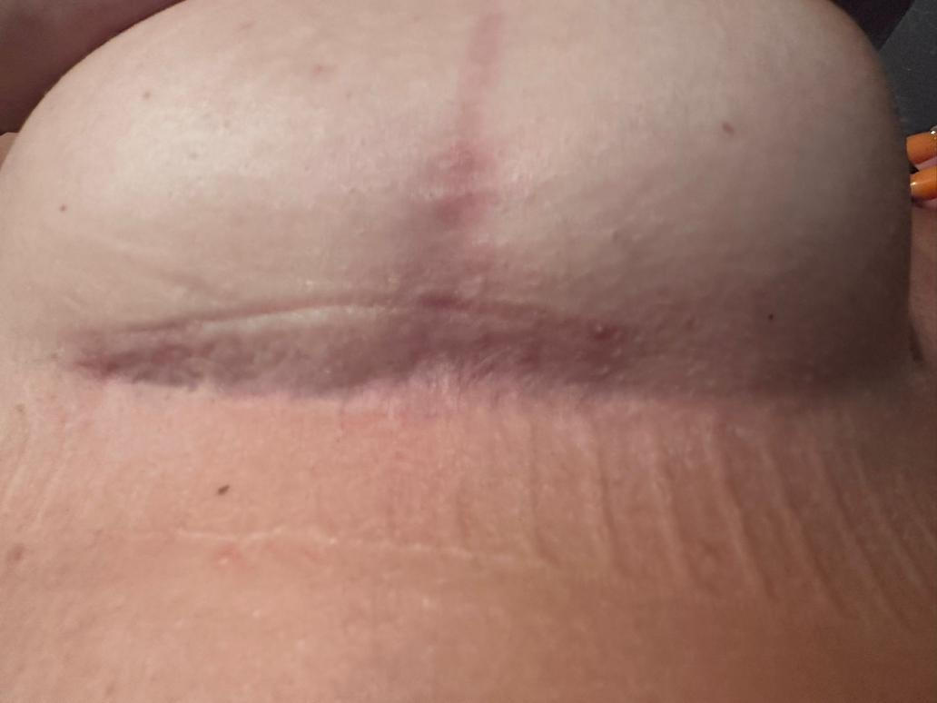 Po plastické operaci prsou: 3/4 roku po zákroku