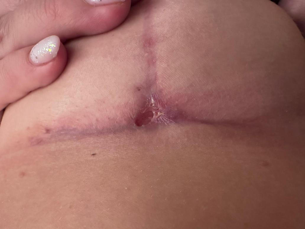 Plastická operace prsou: 3 měsíce od zákroku, kdy se v okolí implantátu objevila infekce zlatého stafylokoka