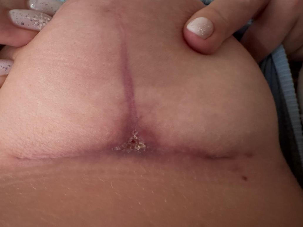 Plastická operace prsou: 3 měsíce od zákroku, kdy se v okolí implantátu objevila infekce zlatého stafylokoka