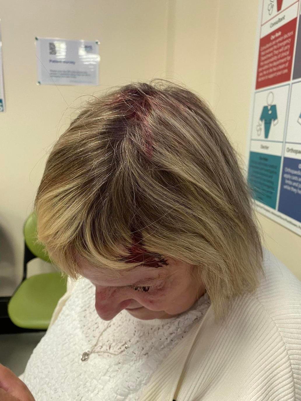 Rána byla tak silná, že Lesley zůstala otřesená a začala jí téct krev. Bolest, šok a pocit bezmoci ji donutili vyhledat lékařskou pomoc, a tak skončila v nemocnici, kde jí ošetřili zranění. Útok zanechal na hlavě jizvu i lysé místo, které jí bude připomínat tuhle nečekanou zkušenost. Lesley si teď klade otázku, proč vlastně racci stále patří mezi chráněné druhy, když dokážou takto nebezpečně zaútočit na nic netušící lidi. Rána byla tak silná, že Lesley zůstala otřesená a začala jí téct krev. Bolest, šok a pocit bezmoci ji donutili vyhledat lékařskou pomoc, a tak skončila v nemocnici, kde jí ošetřili zranění. Útok zanechal na hlavě jizvu i lysé místo, které jí bude připomínat tuhle nečekanou zkušenost. Lesley si teď klade otázku, proč vlastně racci stále patří mezi chráněné druhy, když dokážou takto nebezpečně zaútočit na nic netušící lidi.