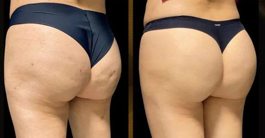 Před a po aplikaci nového liftingu hýždí doktora Roberta Chacura