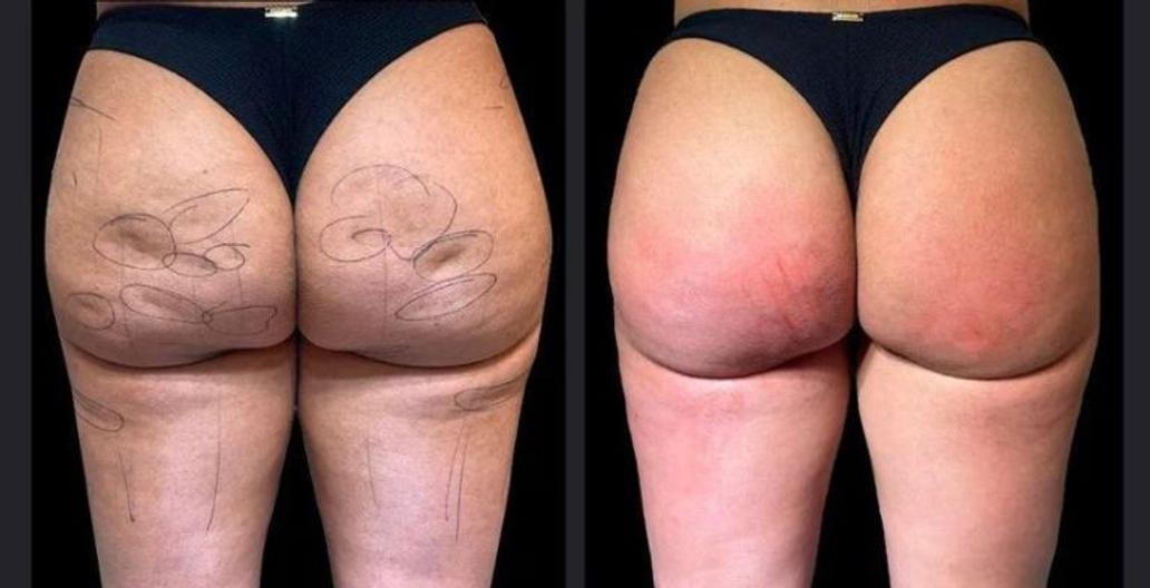 Před a po aplikaci nového liftingu hýždí doktora Roberta Chacura