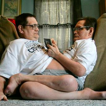 Siamská dvojčata Ron Galyon a Don Galyon