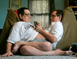 Siamská dvojčata Ron Galyon a Don Galyon