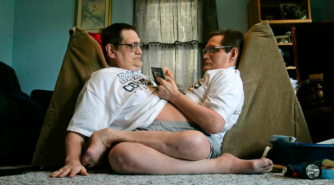 Siamská dvojčata Ron Galyon a Don Galyon