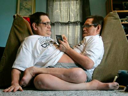 Siamská dvojčata Ron Galyon a Don Galyon