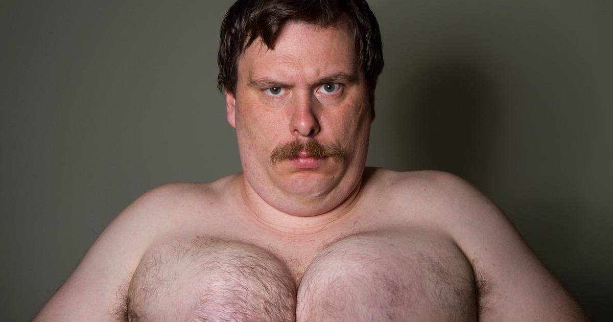 Gynekomastie - zvětšená prsa u mužů