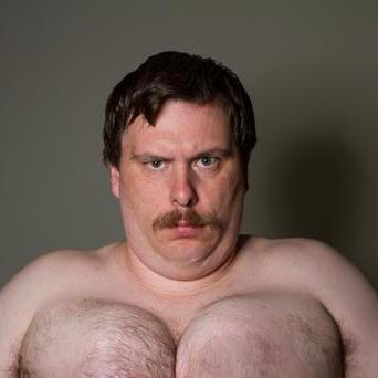 Gynekomastie - zvětšená prsa u mužů