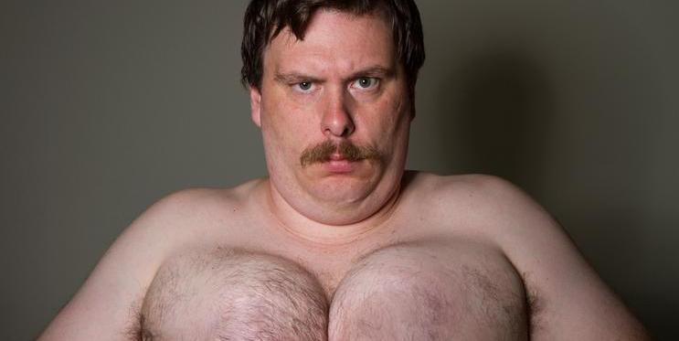 Gynekomastie - zvětšená prsa u mužů