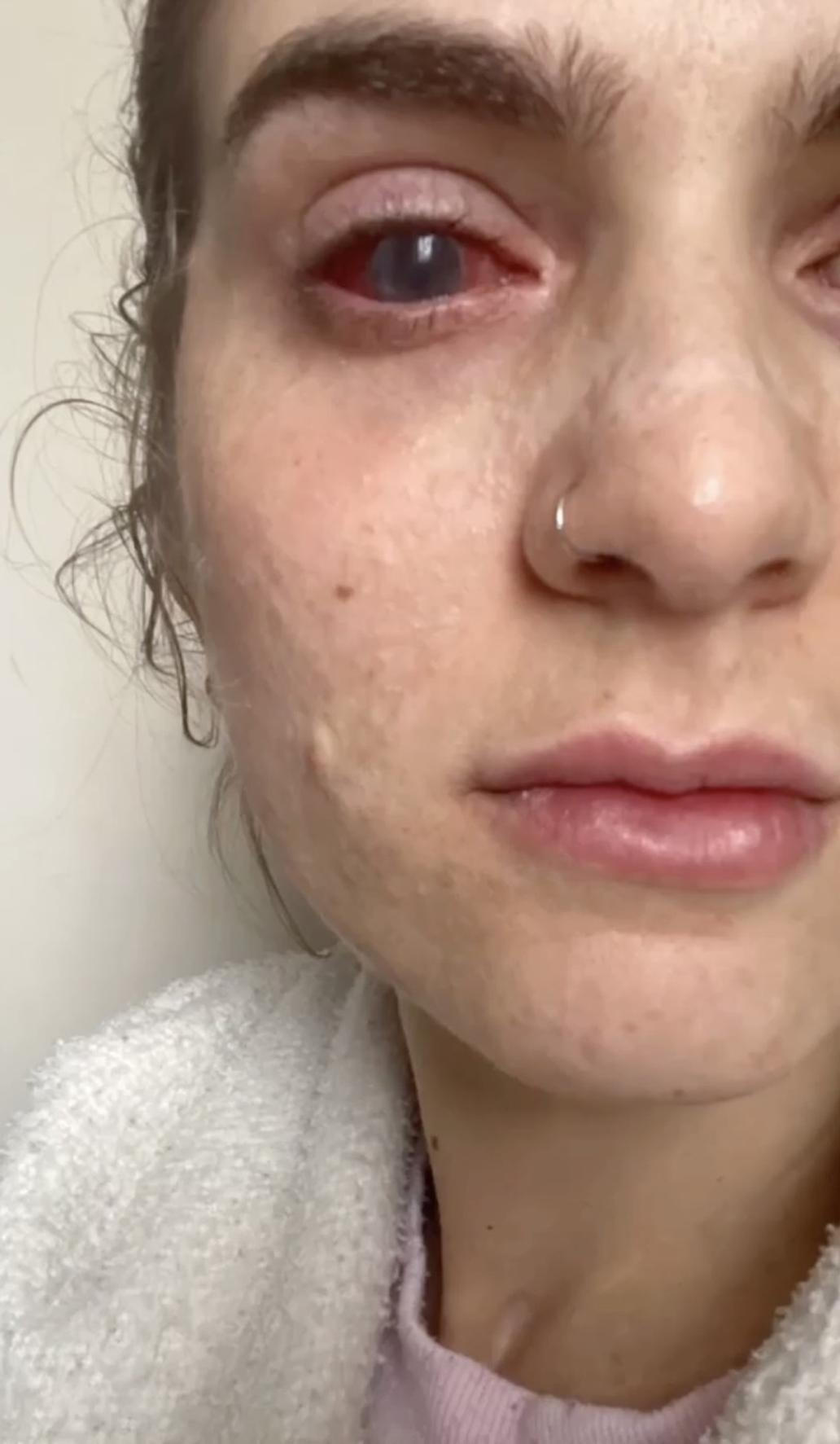 Jaqueline Gmack po ibuprofenu prodělala vzácný syndrom Stevens–Johnson