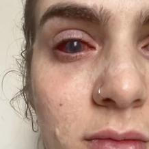 Jaqueline Gmack po ibuprofenu prodělala vzácný syndrom Stevens–Johnson