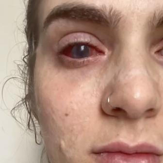 Jaqueline Gmack po ibuprofenu prodělala vzácný syndrom Stevens–Johnson