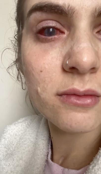 Jaqueline Gmack po ibuprofenu prodělala vzácný syndrom Stevens–Johnson