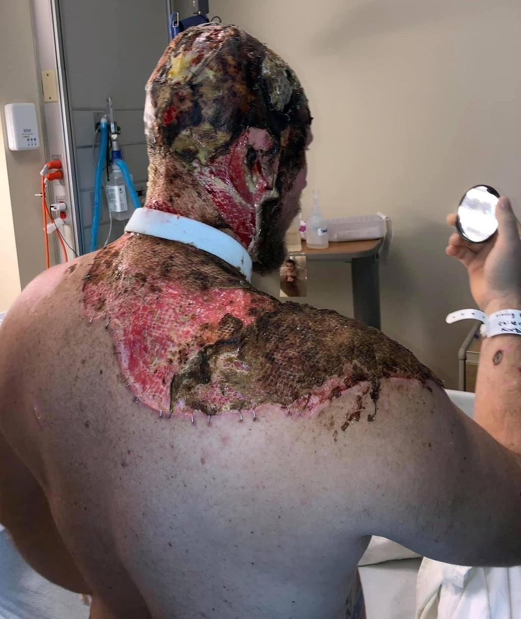 John je bojovník a tak se vzepřel zákonům fyzikálním i lékařským a přežil. V kómatu byl devět dní. Teď se může "chlubit" svými jizvami, krásnou rodinou a velkým životním příběhem. John Pendleton