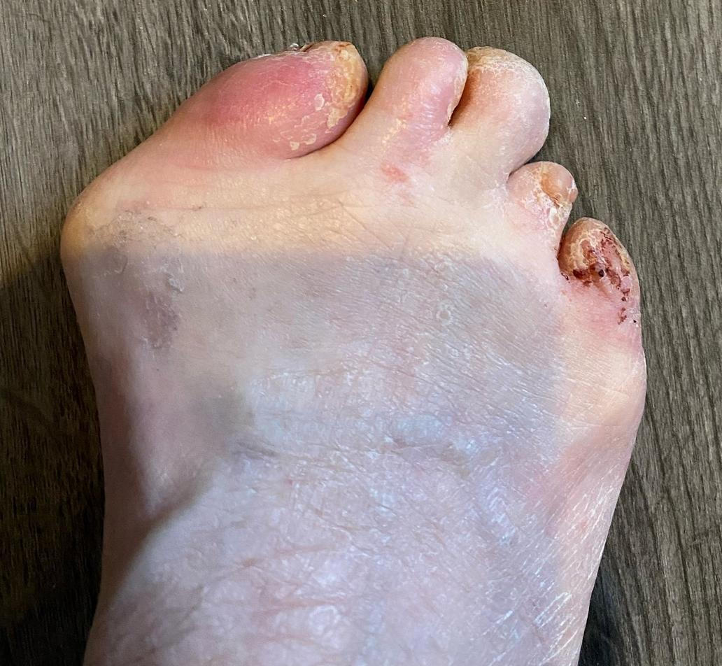 Shirley předtím, než onemocněla po chybě s antibiotiky. Prsty na rukou a nohou po chybě s antibiotiky zčernaly a „odpadly“.