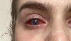 Jaqueline Gmack po ibuprofenu prodělala vzácný syndrom Stevens–Johnson