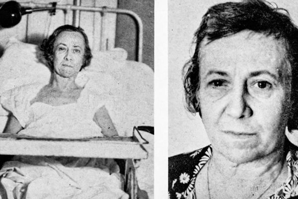 Lobotomy Procedure
Photos show a female lobotomy patient before the procedure and one year later, in 1942.
https://www.livescience.com/42199-lobotomy-definition.html