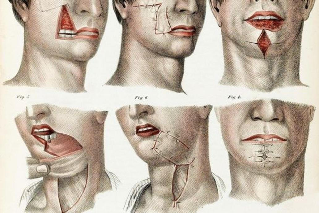 Illustration of facial operative surgery, 1846. From "A treatise on operative surgery comprising a description of the various processes of the art, including all the new operations; exhibiting the state of surgical science in its present advanced condition; with eighty plates, containing four hundred and eighty-six separate illustrations. Second edition, revised and enlarged." By Joseph Pancoast. Published in 1846.,Image: 245858191, License: Rights-managed, Restrictions: , Model Release: no, Credit line: Profimedia