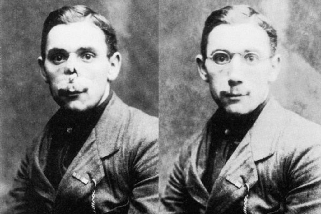 Cca po roce 1914
After the First World War, American sculptor Anna Coleman Ladd (1878-1939) ran the Studio for Portrait Masks in Paris, administered by the American Red Cross. With her four assistants, she made lifelike masks for disfigured French soldiers. Her workroom photographs document the "before and after" faces of each disfigured (left) and masked (right) soldier. After the patient's injury and/or restorative surgeries had healed, Ladd would take a plaster cast of his face. A mask was then crafted out of paper-thin galvanized copper and carefully painted to match skin color. Some even had real-hair mustaches. Every mask took at least month to make. Neither function nor mobile expression could be restored, of course, but after their "plastic surgery," the grateful soldiers were able to return to their families and rejoin society without being shunned. In 1932, Ladd was made a Chevalier of the French Legion of Honor.,Image: 245696508, License: Rights-managed, Restrictions: , Model Release: no, Credit line: Profimedia