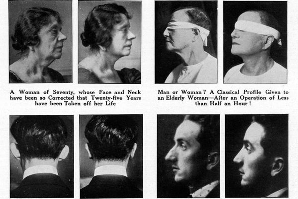 Examples of patients who have undergone plastic surgery in the 1920s, to accompany an article in "The Sphere" magazine, entitled "New Faces for Old.",Image: 674387557, License: Rights-managed, Restrictions: , Model Release: no, Credit line: Profimedia