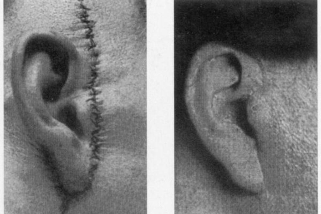 Improvements in Plastic Surgery, Before and After, c. 1920s
These two images show improvements in plastic surgery, c. 1920s. On the left is a prominent scar from a cheek lift. On the right is a cheek lift in which the surgeon made an incision behind the ear, leaving no scar. The person who revised this technique was German plastic surgeon Jacques Joseph (1865-1934).,Image: 245696526, License: Rights-managed, Restrictions: , Model Release: no, Credit line: Profimedia
