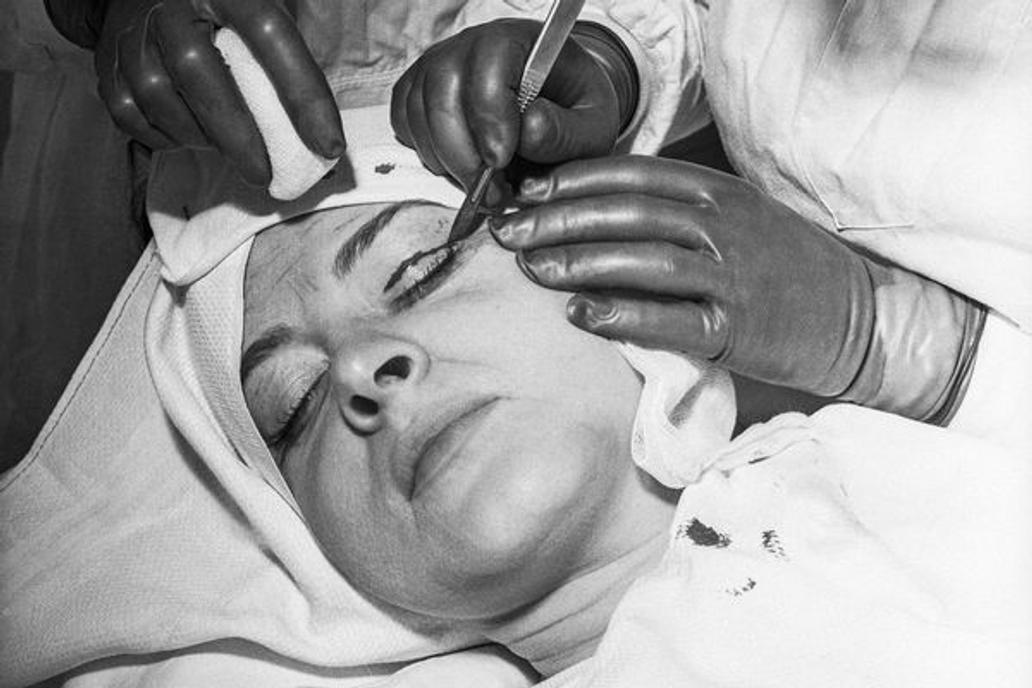 Undated Photograph-The deepest marks of strain and age are always visible around the eyes. That is the area in which the plastic surgeon works special success.