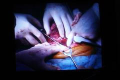 Operace siamských dvojčat