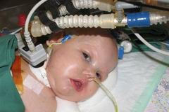 Siamské dvojče Michael už reaguje očima