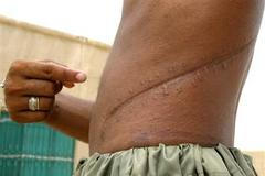 Transplantace ledviny