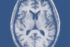 Mozek. Ilustrační foto.