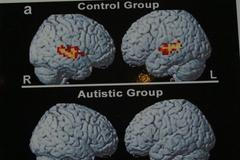Autismus - mozek