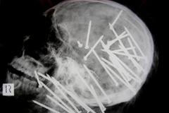 Mrtvý Číňan měl v hlavě více než třicet hřebíků