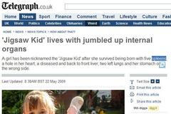 "Skládačkové dítě" žije se spřeházenými orgány