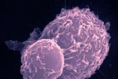 Rakovina tlustého střeva