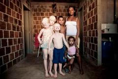 V černošské rodině se narodili tři albíni