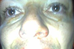 Michal Babák po bitce v baru