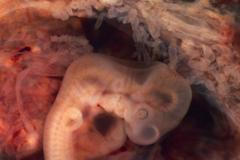 Plod - mimoděložní těhotenství