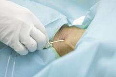 Laparoskopická operace jícnu