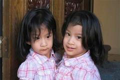 Američtí lékaři úspěšně oddělili dvouroční siamská dvojčata