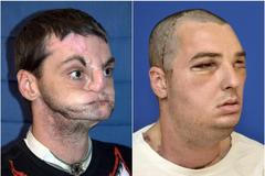 Richard Norris - dosud nejrozsáhlejší transplantace lidského obličeje