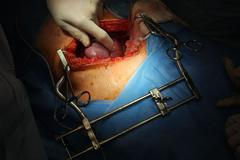 Transplantace ledviny od kamarádky