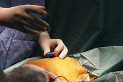 Laparoskopická operace jícnu